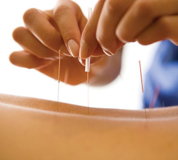 Acupuncture Can Help with IBS, Chron’s Disease and Ulcerative 