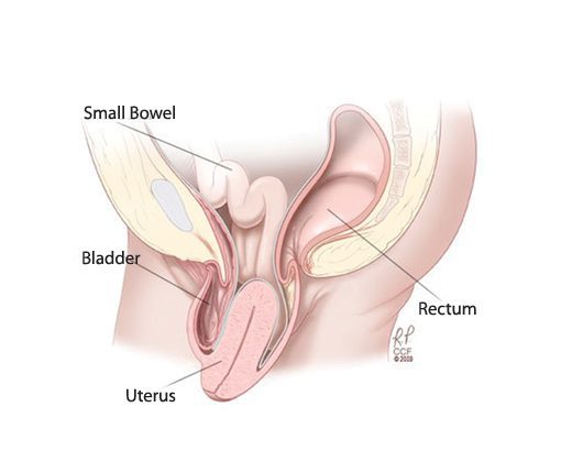 Urogynecology: About Pelvic Organ Prolapse :: Minnesota Women's Care OBGYN  and Urogynecology