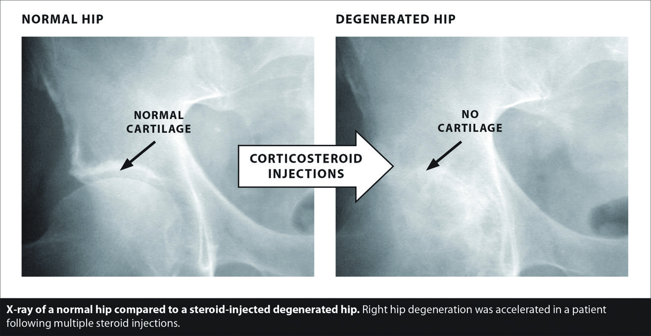 Treatment Options For Osteoarthritis Of The Hip Southwest Florida S Health And Wellness Magazine