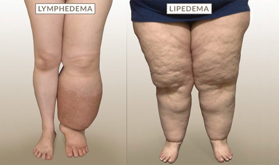 Lipedema vs. Lymphedema
