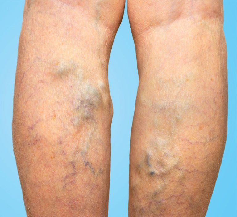 Did You Know That Men Can Get Varicose Veins Too? Southwest Florida's