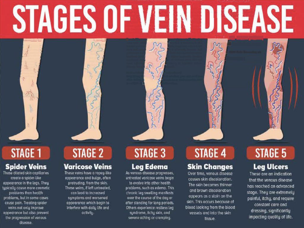 Venous insufficiency is a disease process which can affect all age groups.