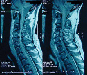 Is Spinal Stenosis the Cause of Your Back Pain