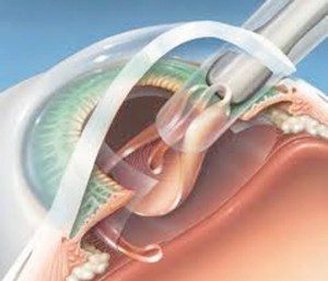 What are Intraaocular Lens Implants