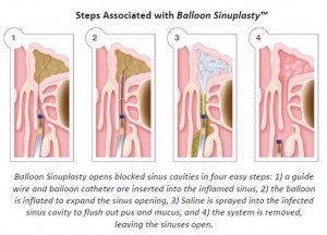 A Breakthrough in Endoscopic Sinus Surgery