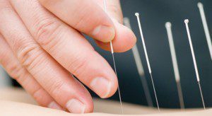 Acupuncture Relieves Pain