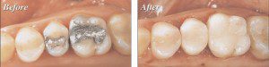 All in one Dental Visit with CEREC