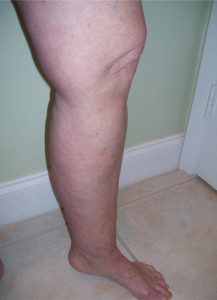 DEBUNKING THE  MYTH OF CANKLES