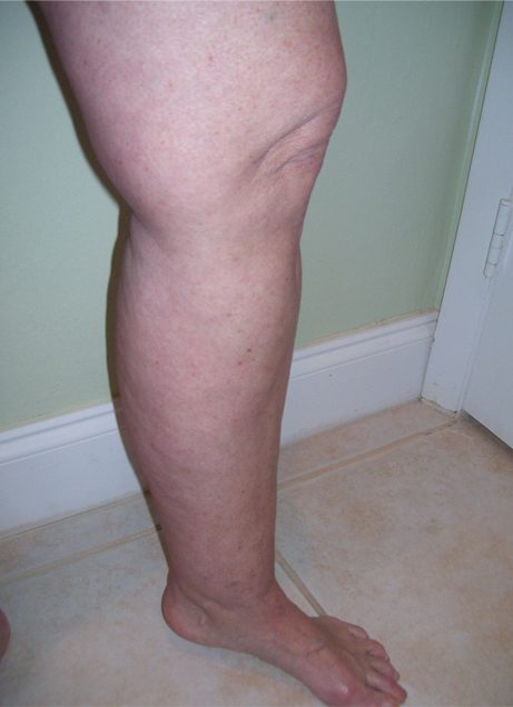 DEBUNKING THE MYTH OF CANKLES • Southwest Florida's Health and Wellness ...