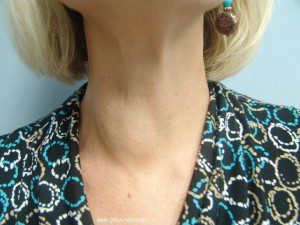 What to Know about Thyroid Nodules