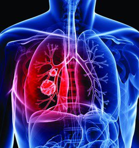 CT Lung Scan – Should You be Screened