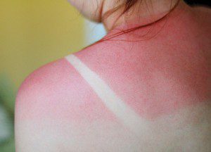 Does Your Sunburn Require Medical Treatment