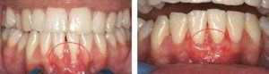 Gum Lift Surgery for Gingival Recession Treatment