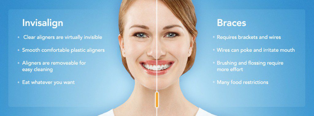 Benefits of Invisalign and Straight Teeth