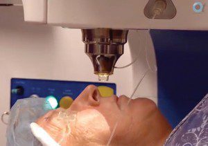 VICTUS Cataract Surgery Laser precision