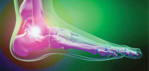 Heel Pain Interfering with Your Daily Activities