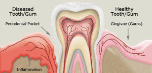 Gum Disease Linked to Autoimmune Disorders