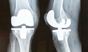 Knee Pain Does Not Mean You Need Knee Replacement Surgery