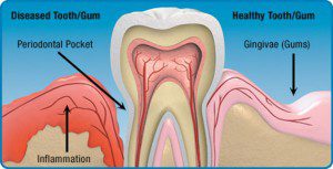 What Is Gum Disease