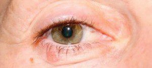 Detecting And Preventing Eyelid Cancer