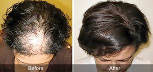 Hair Restoration Naturally With Laser Hair Therapy