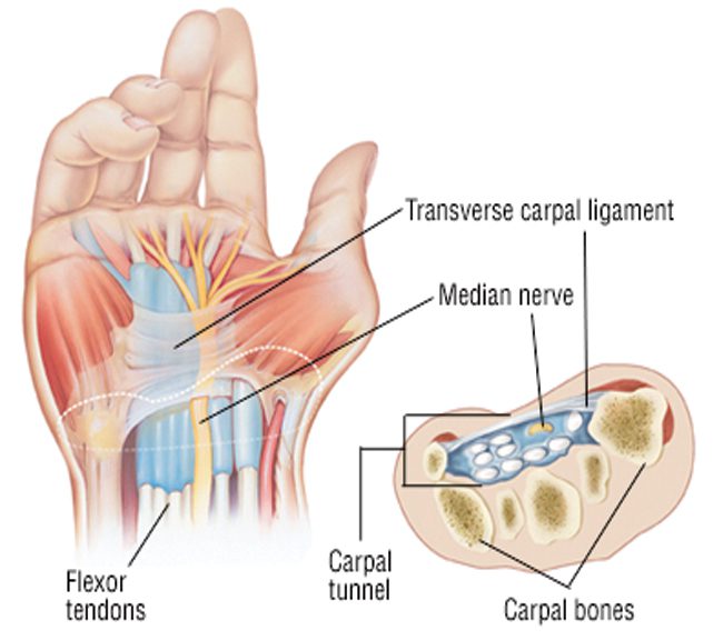 Understanding Carpal Tunnel Syndrome • Southwest Florida's Health And 