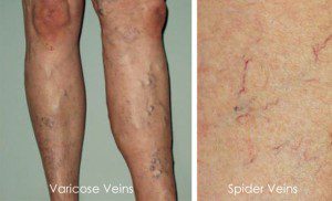 Varicose and Spider Veins