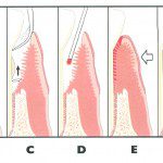 Laser Periodontal Therapy