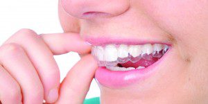 Best Smile with Invisalign