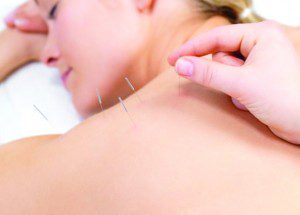 Balance Method of Acupuncture