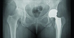 Comprehensive Care for Hip Problems