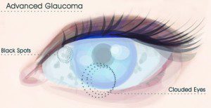 Risks of Glaucoma