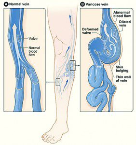 superficial venous insufficiency