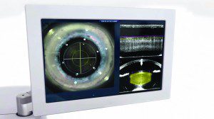 Laser Cataract Surgery