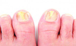 embarrassing toenail fungus