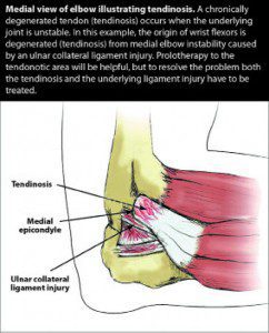 Prolotherapy