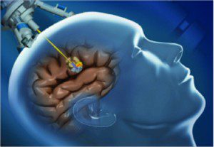 NeuroBlate System