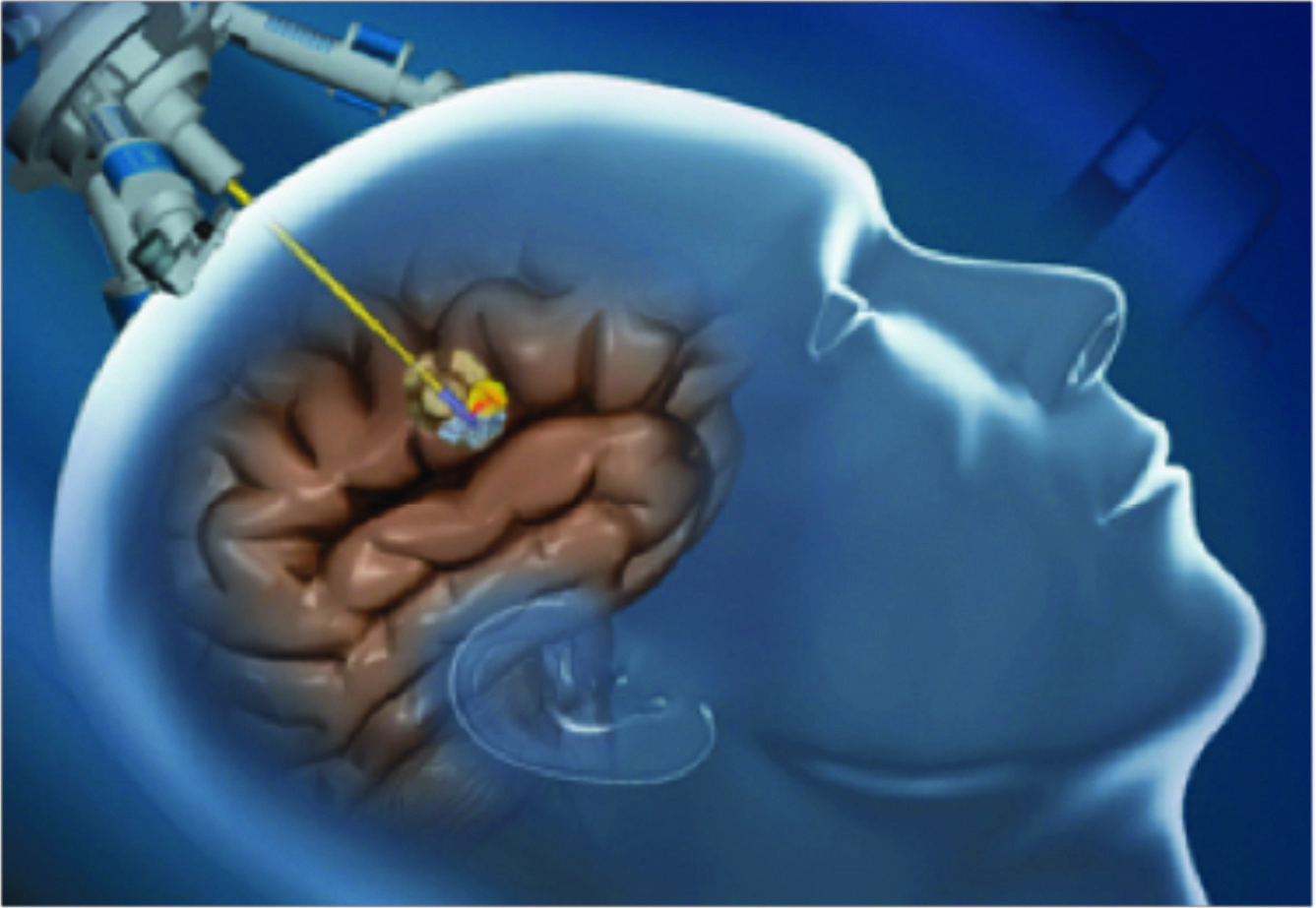 Оперирование опухолей головного мозга