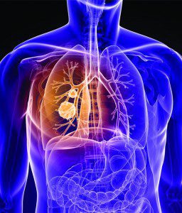 ULTRAFAST CT LUNG SCREENING