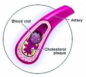 Cholesterol testing is not enoug