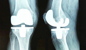 Knee Replacement Surgery