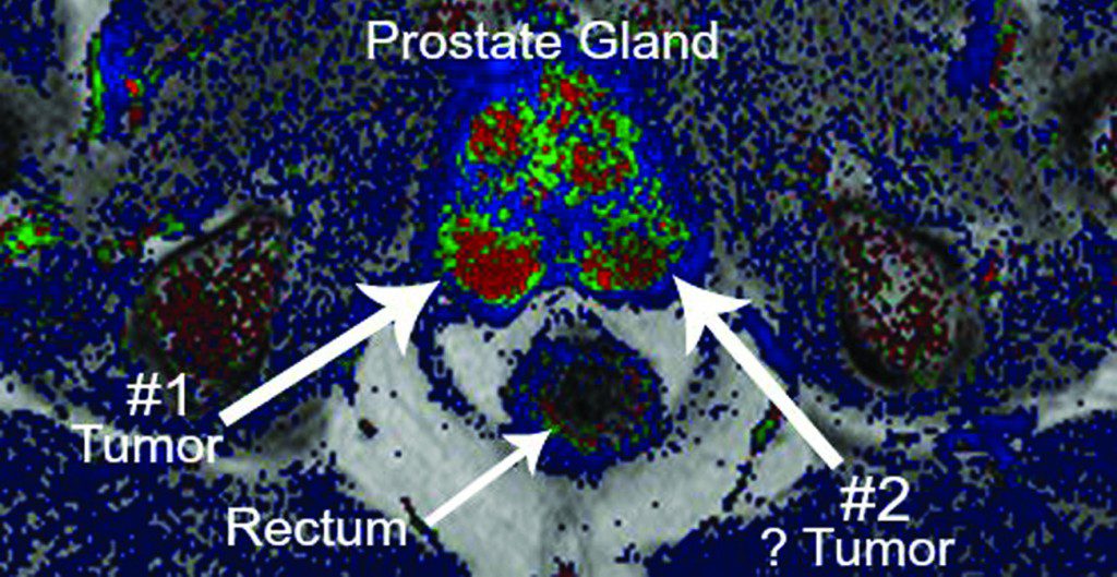 Emerging Technology with MRI Available to Detect Prostate Cancer ...