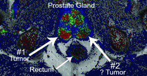 MRI Available to Detect Prostate Cancer