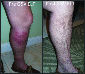 Top 7 Reasons to Get Your Leg Vein Evaluation