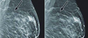 A New Era in Breast Imaging