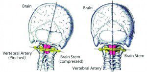 Upper Cervical Care