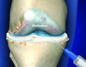 Prevent Surgery with Knee Injections