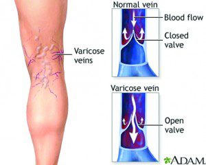 Varicose and Spider Veins What you need to know?