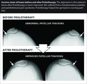 Regenerative Injection Therapy