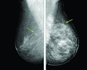 3D Mammography